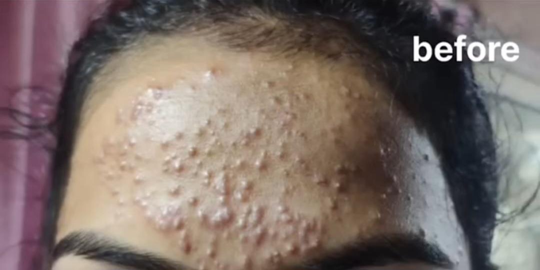 Skin Treatment Before